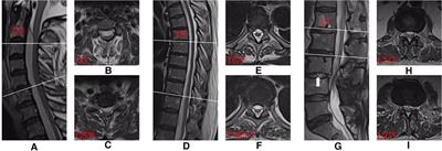 Extensive spinal epidural abscess caused by Staphylococcus epidermidis: A case report and literature review